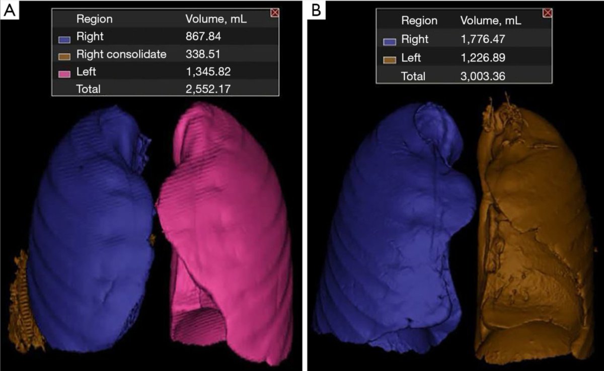 In this article by Hailey Shepherd, MD, surgical residents and #WashUThoracic faculty, the team showcased how they utilized CT volumetry as an adjunct to decision-making regarding the suitability of lungs: jtd.amegroups.com/article/view/7…