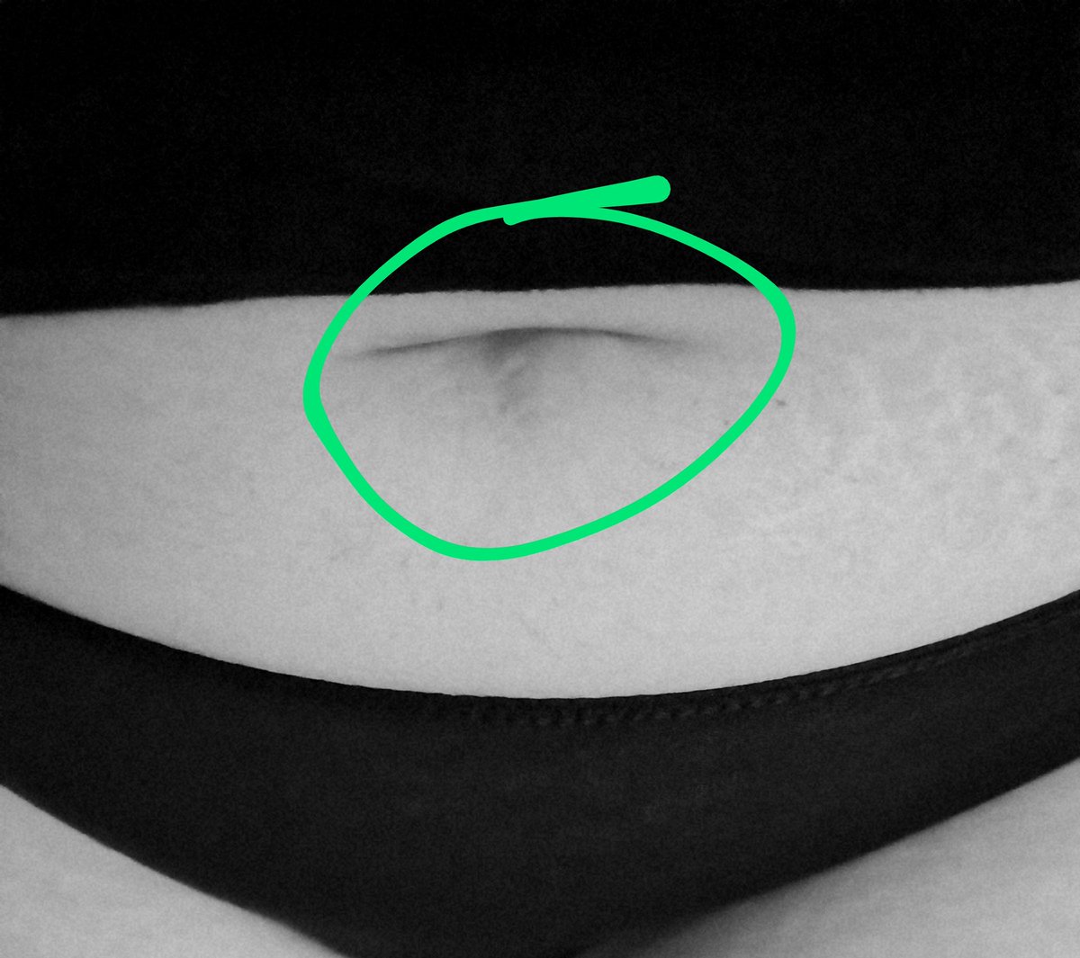 Moderngirlsendo's tweet photo. One of the many scars in my belly button turned 16 this week.

Way back when I was first diagnosed, I naively thought that because I finally had a name for what was wrong with me, it'd be easy for them to fix me.

The older, wiser me knows that's not the case. https://t.co/n4b1ocj5WR