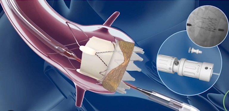 heartcaredom's tweet photo. Jornada de Estenosis Aórtica.  Gracias @urenacard  la doctora @draimeeflores @drscottlim  @MikeRagosta  @uvahealth
@seminsaoficial, apoyandonos con su válvula ACURATE neo2 de @bostonsci 
@saludpublicard @lucydoughty @voluntariadobr 
#HeartCareDominicana #FunracionHeartCare https://t.co/qTVCS25qga