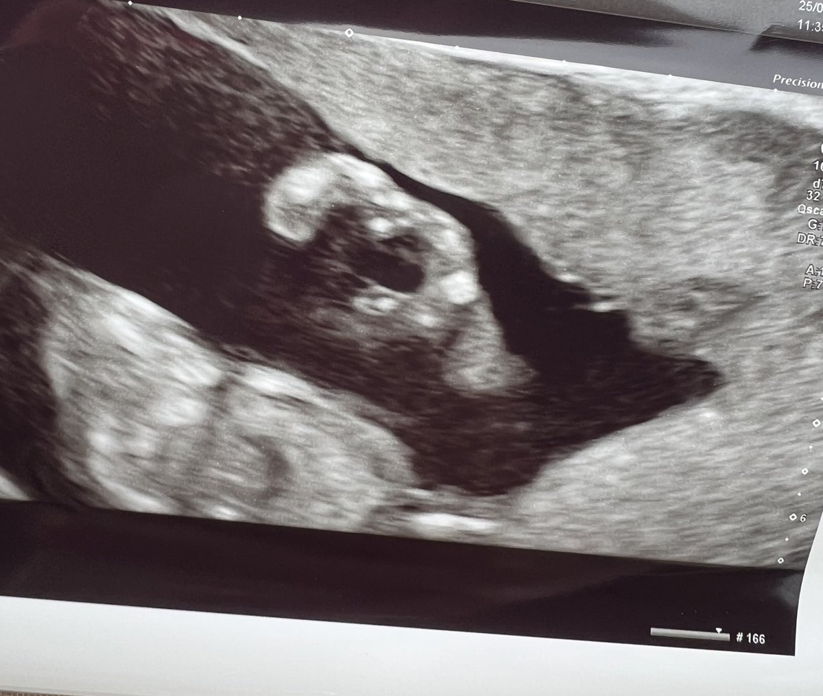 jclarkx's tweet photo. Baby Cran showing us some love with its little hands 🫶🏻 
Half way to meeting you 🤍 https://t.co/AFIalFjoxL