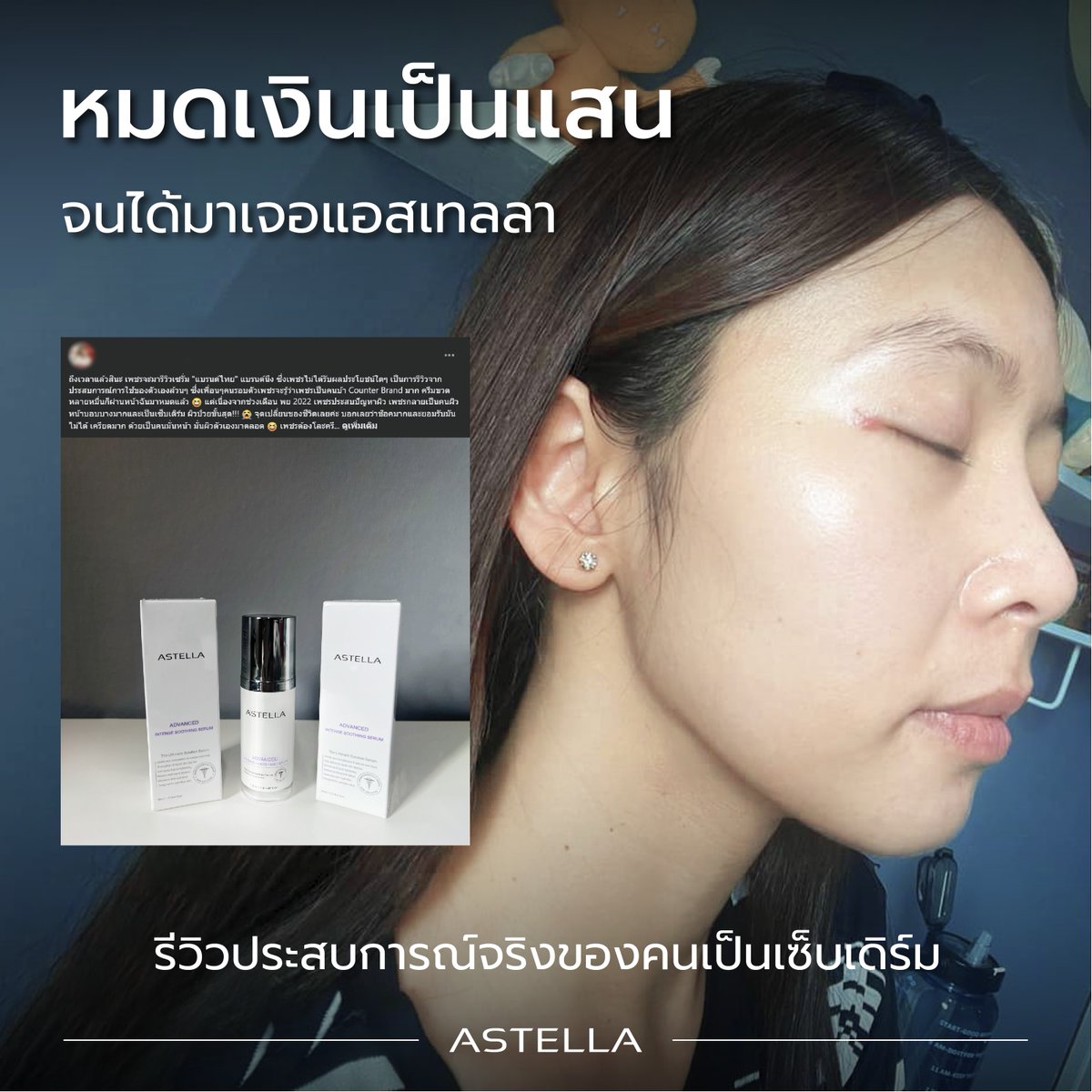 AstellaThailand's tweet image. "ขอบคุณทางแบรนด์ที่สร้างสิ่งดีดีขึ้นมา เพชรเป็นกำลังใจให้ทำต่อ อย่าหยุดทำนะคะ" นี่คือ...เสียงของคุณลูกค้าที่ต้องเผชิญกับ #เซ็บเดิร์ม
.
จากผู้ที่หมดเงินไปแสนกว่าบาท ที่ตอนนี้เรากล้าพูดได้ว่า จ่ายแค่หลักพันก็กลับมามีผิวที่สวย คุมอาการ #Sebderm ได้
.
ขอบคุณที่วางใจและเชื่อมั่นให้