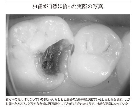 STansuke's tweet photo. 虫歯は削らなくても自然治癒力で自然に治る

『名医は虫歯を削らない　虫歯も歯周病も「自然治癒力」で治す方法』小峰一雄 (著)
1/⬇️ https://t.co/6gOEj4c9Ix