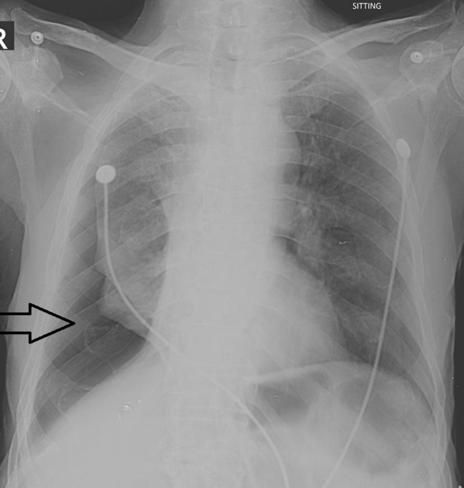 Patient status post MVA. What is the arrow likely pointing to?  #MedTwitter #radtwitter #radiology #meded #MedStudentTwitter #medstudents (image: Cureus)