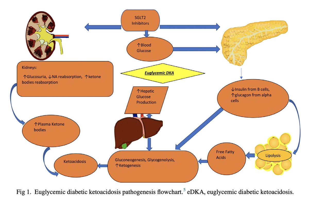 👉Postoperative #EuglycemicDiabeticKetoacidosis occurred in 15% of patients on an sodium-glucose cotransporter 2 inhibitors #SGLT2i prior to cardiac surgery
👉Associated with longer ICU L#OS
👉Future studies into SGLT2i management perioperatively important
jcvaonline.com/action/showPdf…