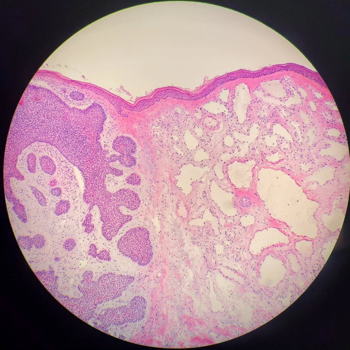 drvitalyt's tweet photo. Mohs surgery frozen section of the week - collision of a basal cell carcinoma with a lymphangioma. https://t.co/osLiDnuJrd