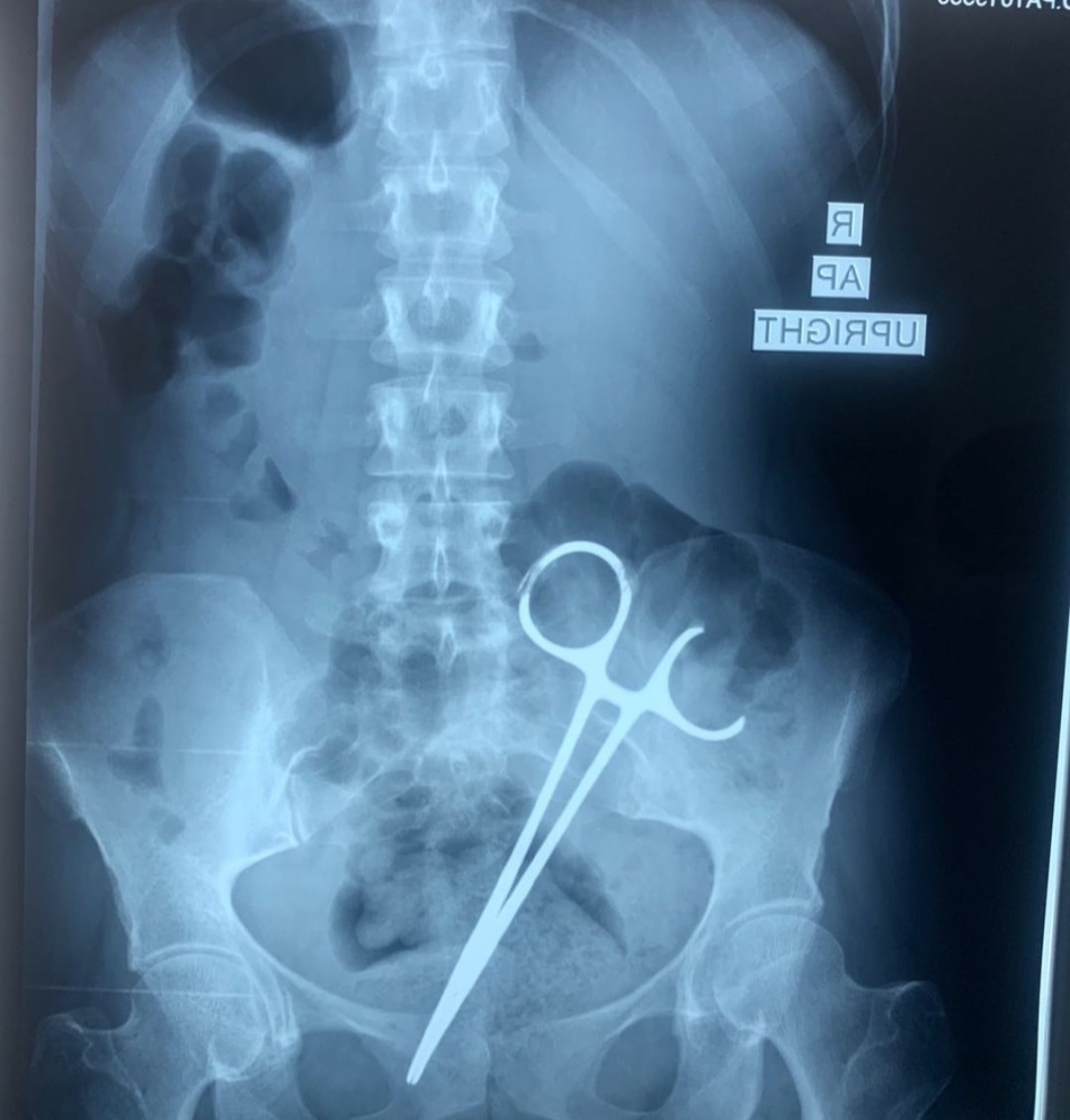 AmenElhashmi87's tweet photo. A scissor has been removed from a girl’s abdomen in a local clinic in Benghazi, east #Libya, 8 years after surgeons in #Jordan left it inside her during an operation. https://t.co/b5nwBSXNIc