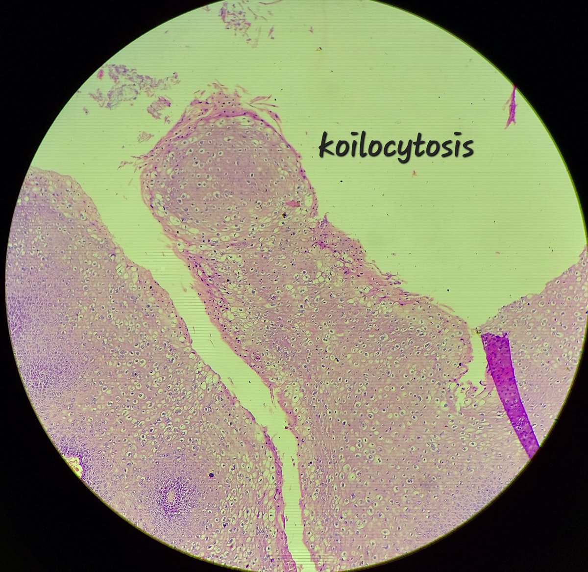 padmapathology1's tweet image. Thank you all for your response. This was Condyloma acuminata.
🔬1️⃣Hyperplastic papillary exophytic squamous epithelium
2️⃣Marked acanthosis
3️⃣Parakeratosis
4️⃣Fibrovascular core
5️⃣Koilocytosis (irregular nuclei, binucleate, perinuclear halo)
#gipath #IDpath