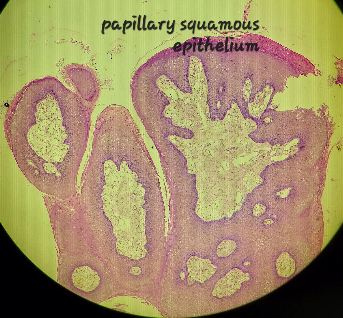 padmapathology1's tweet image. Thank you all for your response. This was Condyloma acuminata.
🔬1️⃣Hyperplastic papillary exophytic squamous epithelium
2️⃣Marked acanthosis
3️⃣Parakeratosis
4️⃣Fibrovascular core
5️⃣Koilocytosis (irregular nuclei, binucleate, perinuclear halo)
#gipath #IDpath