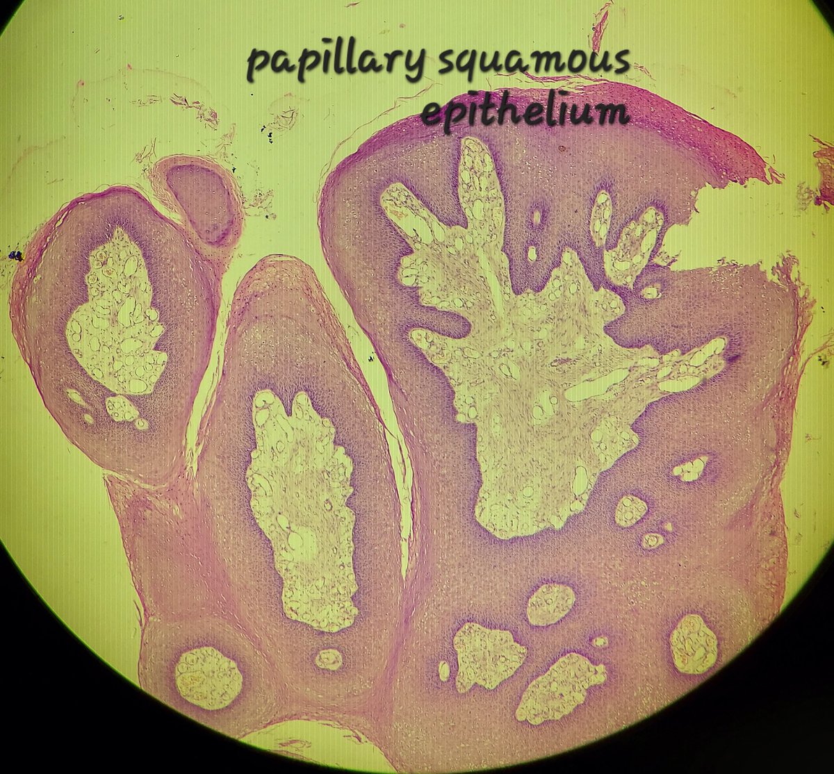 Thank you all for your response. This was Condyloma acuminata.
🔬1️⃣Hyperplastic papillary exophytic squamous epithelium
2️⃣Marked acanthosis
3️⃣Parakeratosis
4️⃣Fibrovascular core
5️⃣Koilocytosis (irregular nuclei, binucleate, perinuclear halo)
#gipath #IDpath