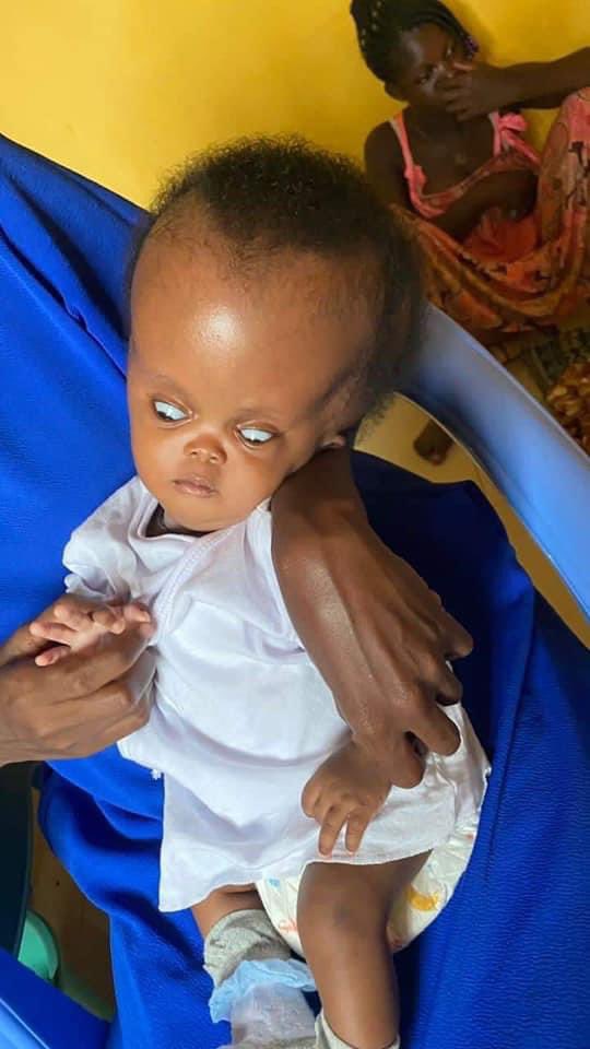 Mariam was born 2 months with excess fluid in the brain Congenital hydrocephalus needs an urgent surgery to pull out the fluid in order to avoid brain damage,mental & physical problems.After the diagnosis & assessment at the KTH,the surgery amount is Gh36,578 
KINDLY RETWEET🥺🙏