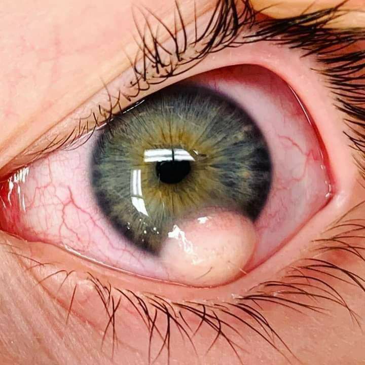 👁️Gradually increasing mass in the eye since childhood. Identify the condition and which syndrome is associated with this condition?
#MedTwitter #ophthalmology #tumour #medicalstudents #MedEd #eyes #Clinical #spotdiagnosis