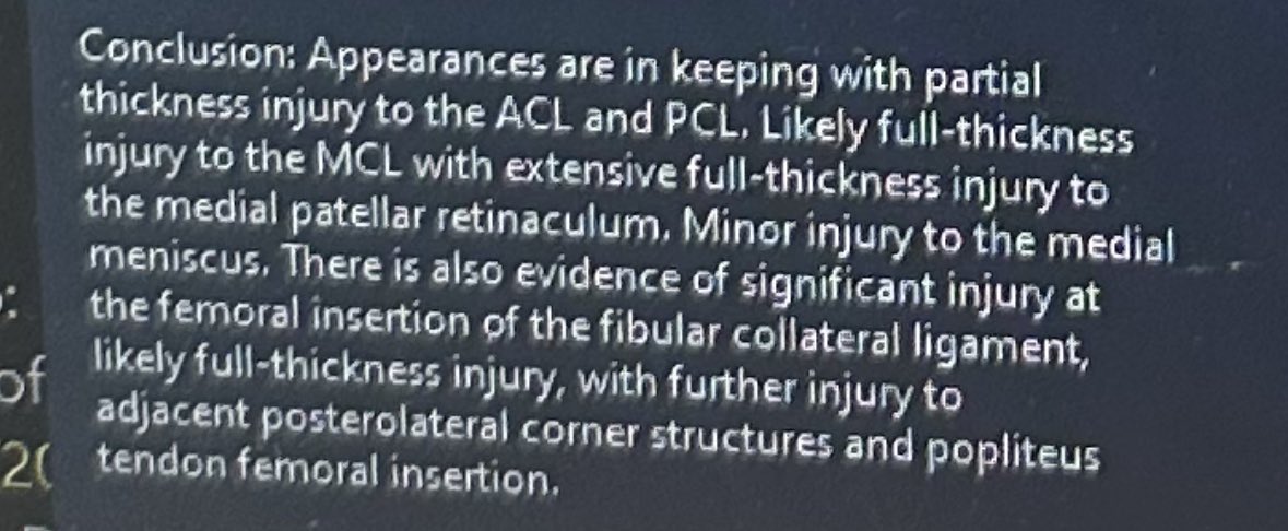 Consolation yesterday, met my doctor who gets the honour of rebuilding the best looking left knee in the UK. I won’t bore you with the full medical report but here is the conclusion. Op in 5 weeks, let’s go champ 💪🏼
#rehab #injury #meniscusrehab #meniscus #acl #aclrecovery #pcl