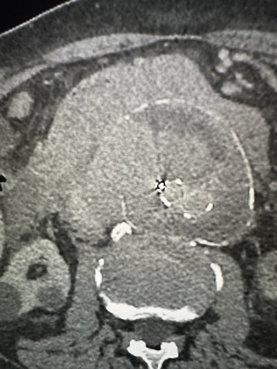 I’m not certain where the endograf leak has occurred that has blown out the native sac. Any thoughts? Focal hemorrhage, extravasation on the venous phase.