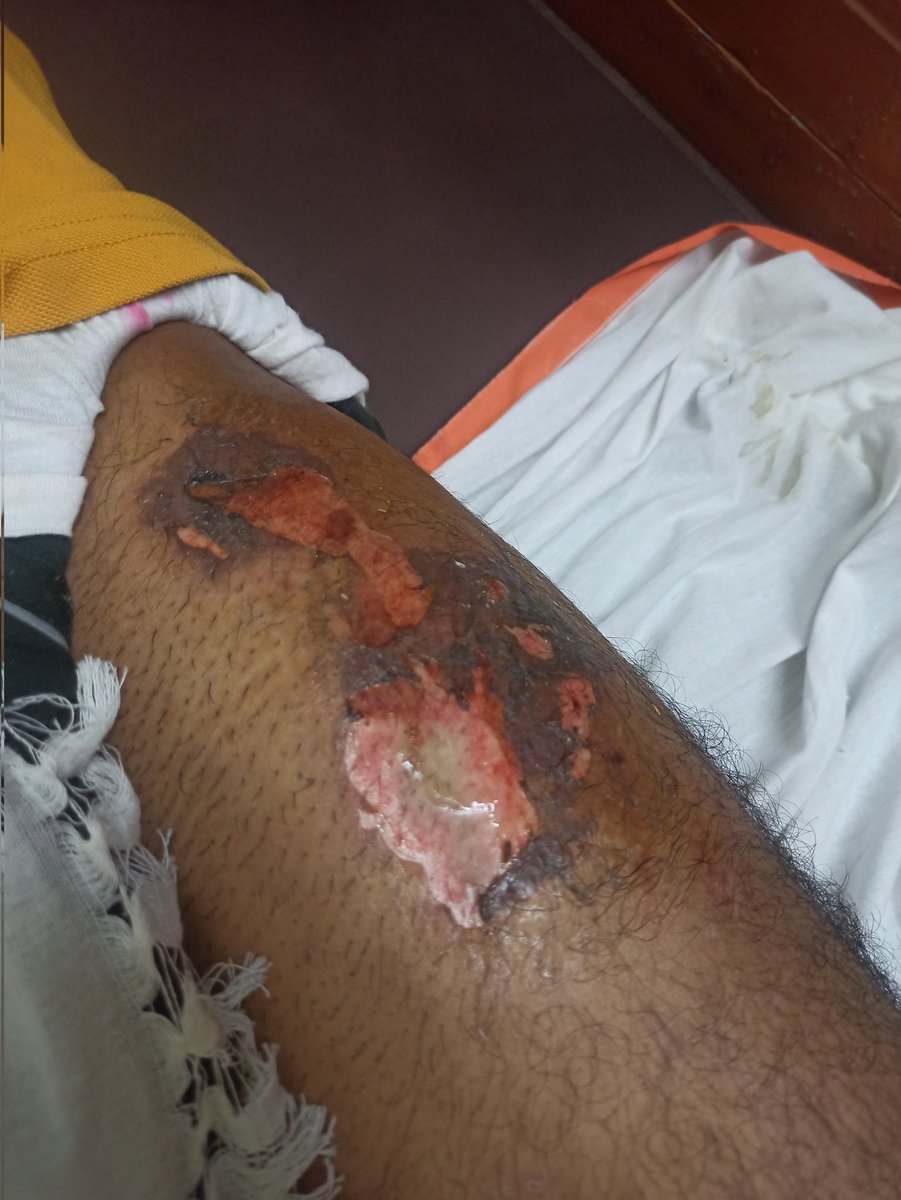Trolling_isart's tweet photo. You must pay attention.

A guy by the name of Vipul purchased a OnePlus Nord 2T on May 4th, and six days later, as he was riding a bike, his smartphone exploded within his pocket.

User was admitted to the hospital following that incident, despite the fact that he is currently in perfect health. 

He contacted OnePlus' customer service and social media teams, and after an inquiry, they determined that the user was responsible for the explosion and not them.

Seriously, what the hell? Will someone risk their lives to harm a company's reputation? 
What do they hope to prove? 

I've spoken to him again, and he wants our assistance in this situation. 

 Pls RT to this and tag OnePlus so that he may get some attention.

This is very very serious and dangerous

Attaching our conversation for your all references.

@OnePlus_IN @OnePlus_Support