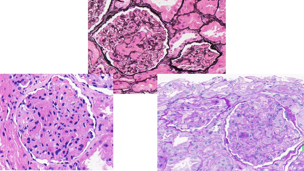 A patient of early/segmental MN with CML. Are those fibrin thrombi stucking in the capillary lumen, or PTC by artifact, or tumor cells infiltration? #renalpath