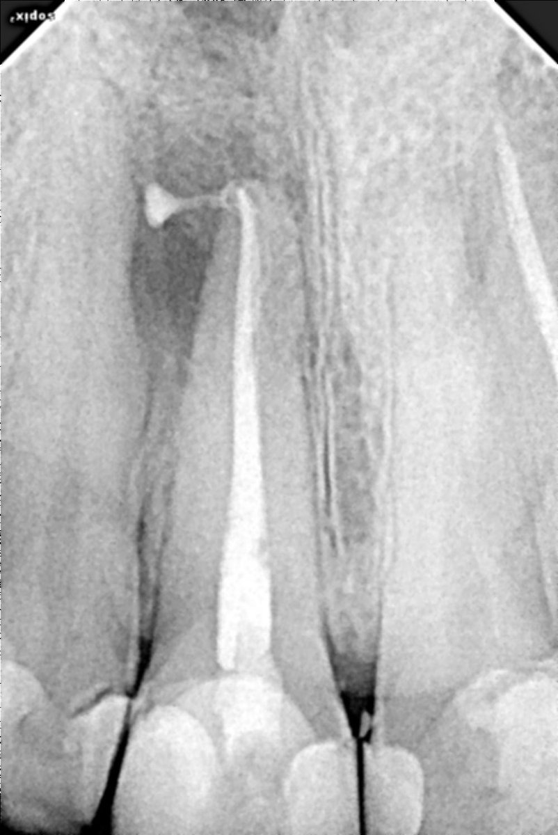 Tooth# 11
Necrotic with symptomatic apical periodontists 
From  Endo to Resto   finished ✅ in 30min🔥