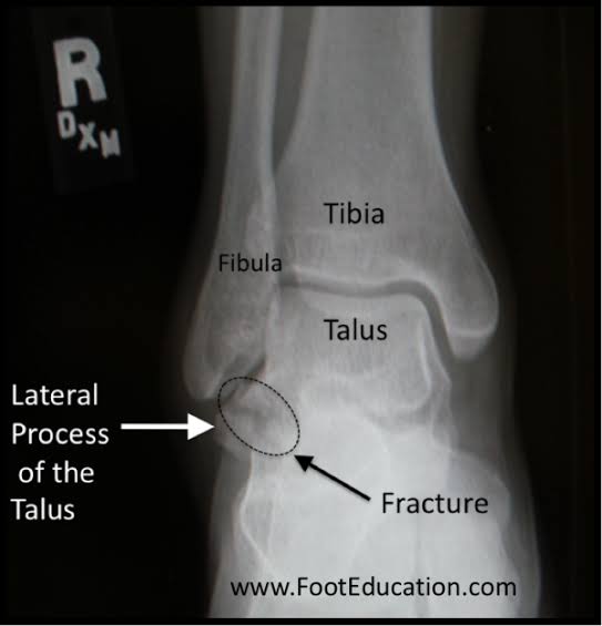 <a href="/northwoods1980/">RJ</a> Snowboarder's fracture
fracture of the lateral process of the talus