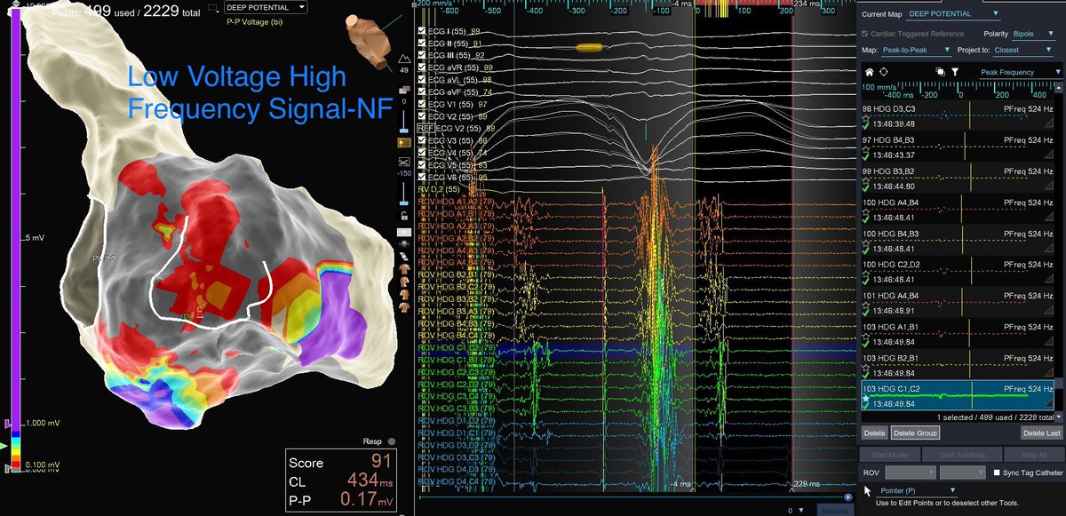 #ablateVT -Excellent correlation b/w Pfrequency Map (ILAM)and Pace Map-99% match with Long stim to qrs 
- done by Dr. Azlan,IJN Malaysia @paklan1967 #EnsiteX #OTNF @murphy_lzy @Hapa_EP @sabarisarav @isha229 @jeffzhanghk2022 @DavidSa29403950 @nimiroiEP @MottolaBrian @mike_lean