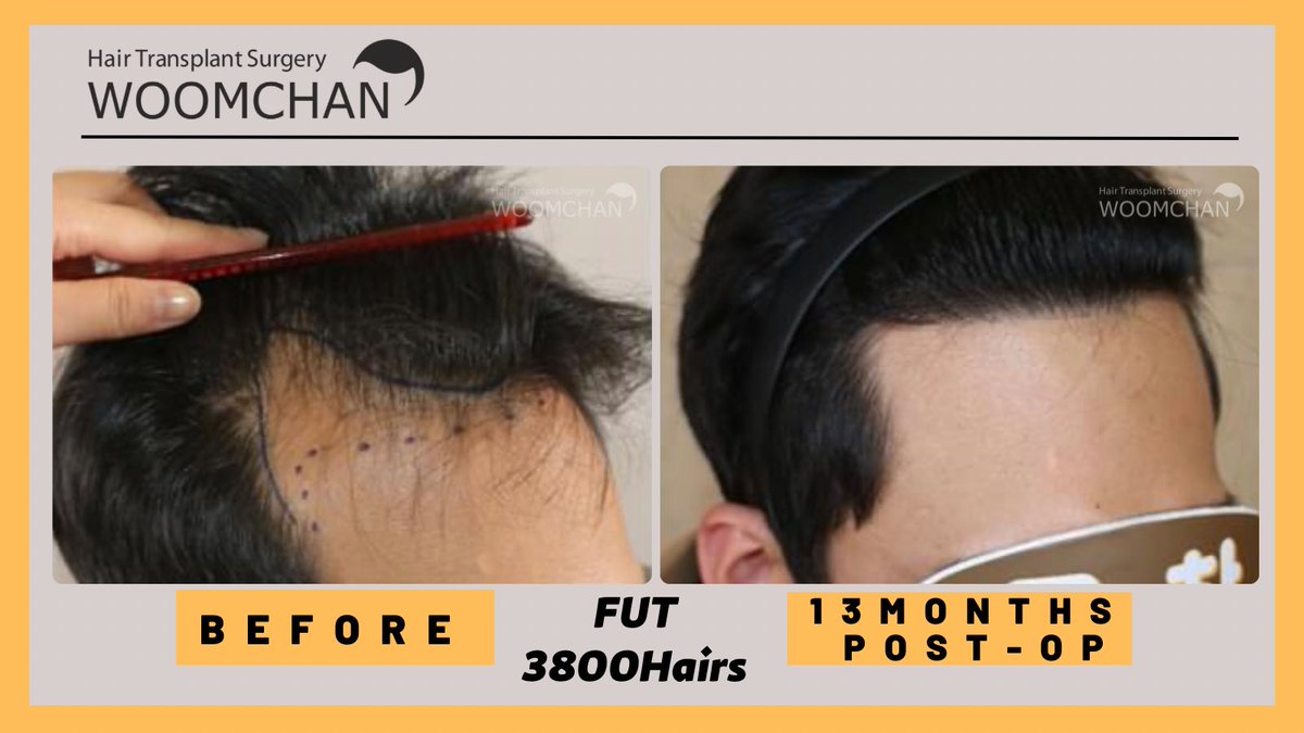 woomchankorea's tweet image. FUT/ 3800Hairs/13months post-op
★Free Consultation:  WhatsApp+821028135827
#FUT  #hairtransplantkorea #mshape