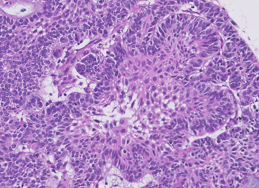 Sellar mass.

Tell me the most common molecular alteration.

#PathTwitter #Neuropath