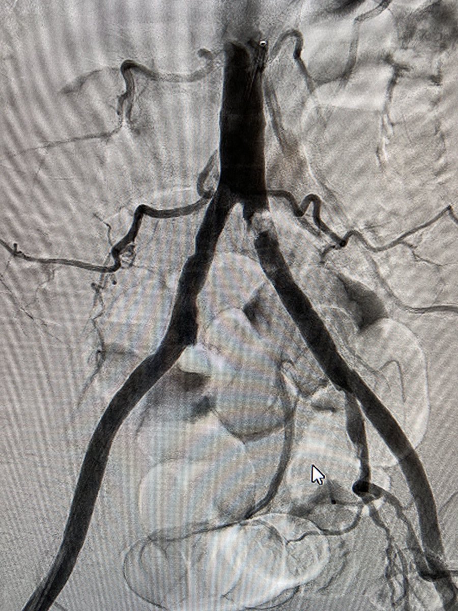 68 year old male former smoker with short distance LLE  claudication. How would you treat? #radres #MedEd #irad