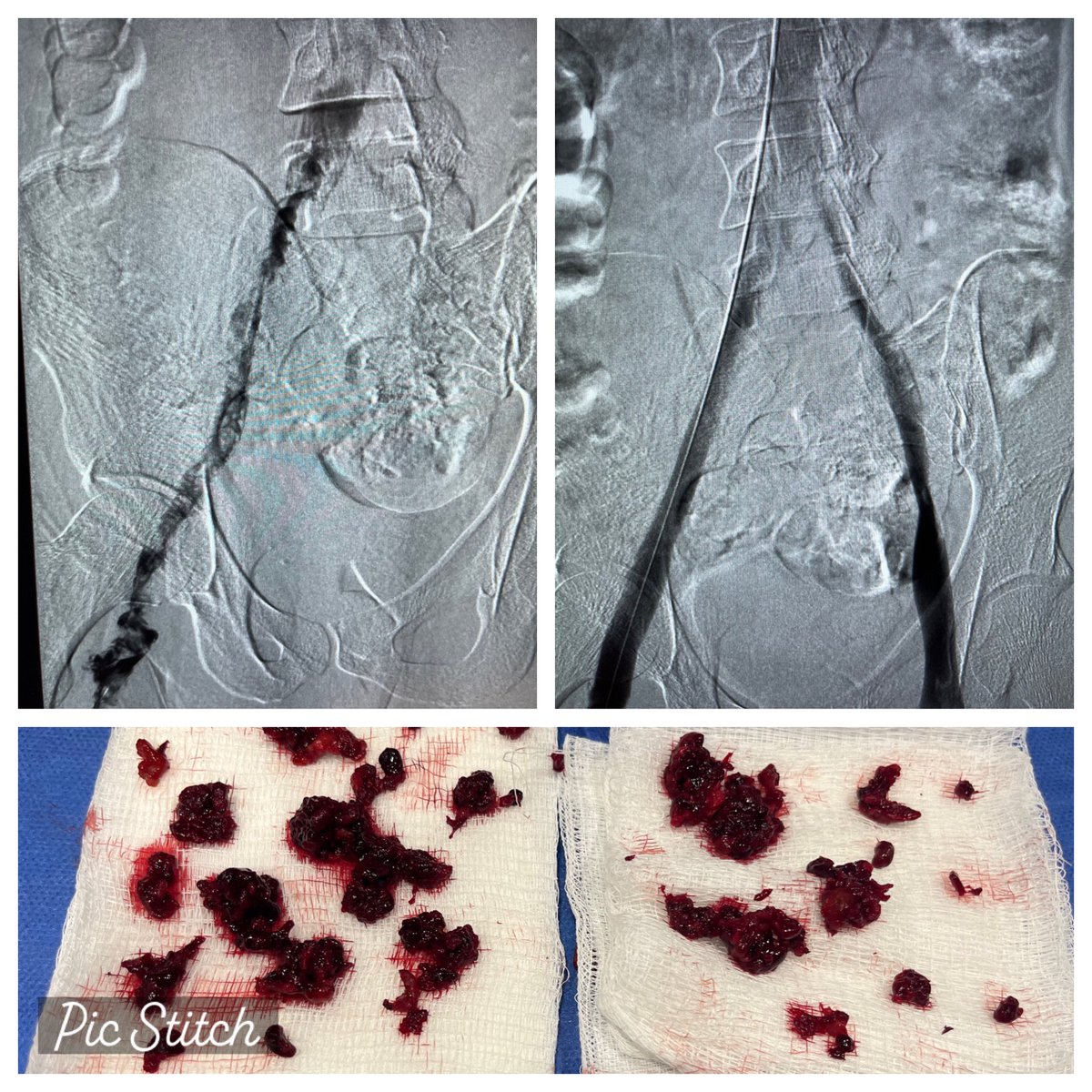 SMPatelMD's tweet photo. The Veins of Lima—R TOS rib resect, electrocautery For uncrossable CTO had to stent (attempted at 3 other hospitals); 2 acute large symptomatic dvt; chronic bilateral MTS with PTS—it’s really a fellowship! #cathelectrosurgery #ECART https://t.co/9bEL1v5OcH