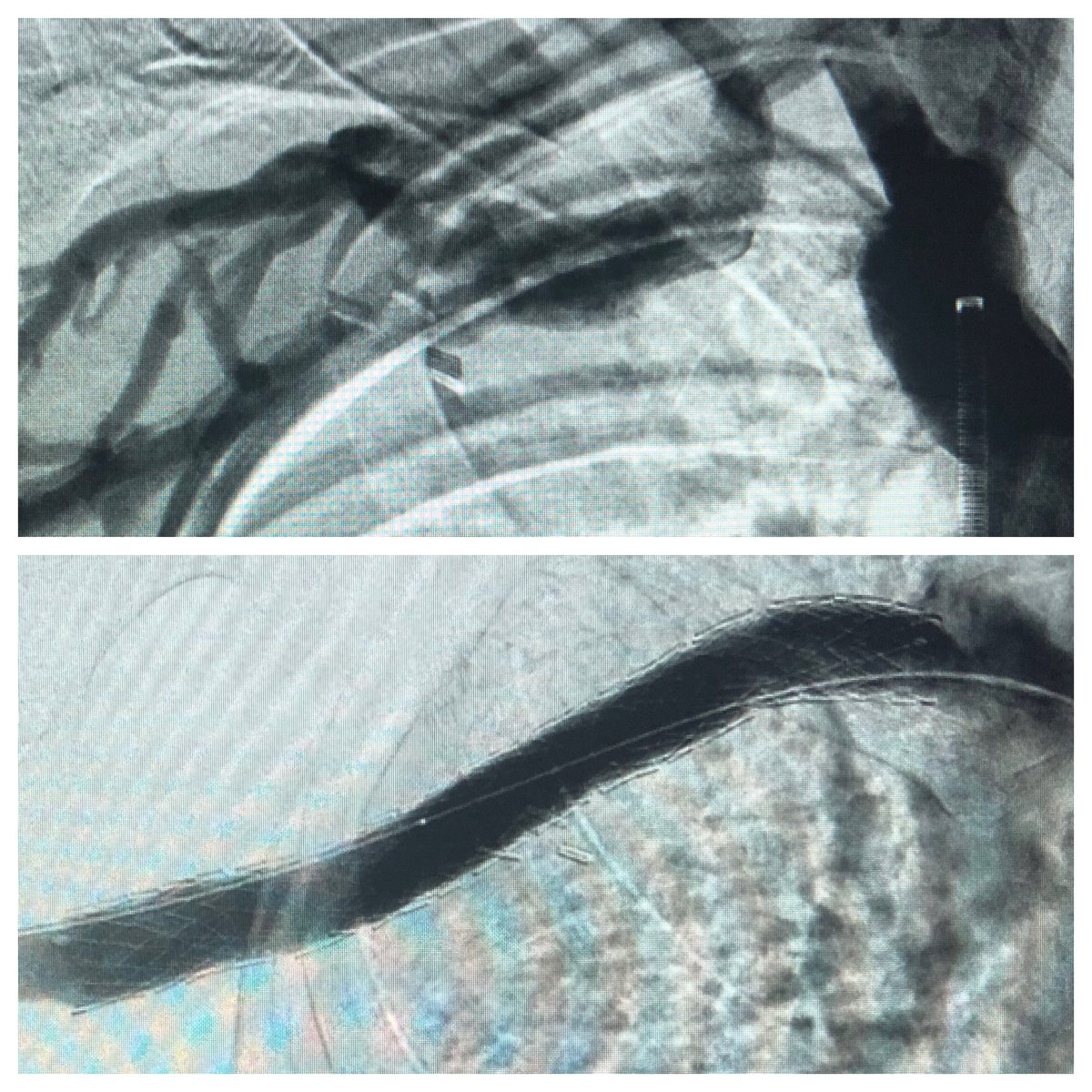 SMPatelMD's tweet photo. The Veins of Lima—R TOS rib resect, electrocautery For uncrossable CTO had to stent (attempted at 3 other hospitals); 2 acute large symptomatic dvt; chronic bilateral MTS with PTS—it’s really a fellowship! #cathelectrosurgery #ECART https://t.co/9bEL1v5OcH