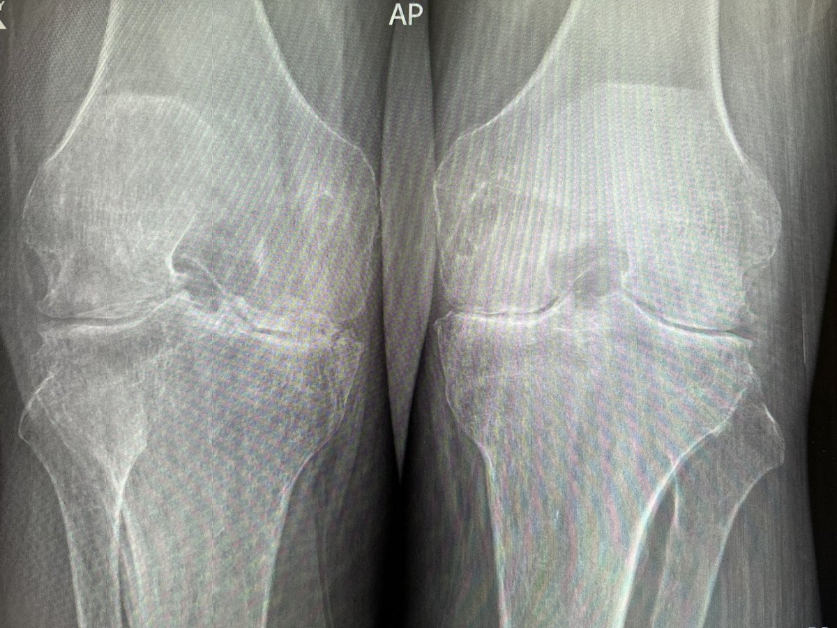 50s male, poorly controlled RA, rom 45-100. What are the chances of getting full extension with a standard ps knee? Or will this require releasing the collaterals and putting in a hinge? Obviously will have it all available…Appreciate everyone’s advice!