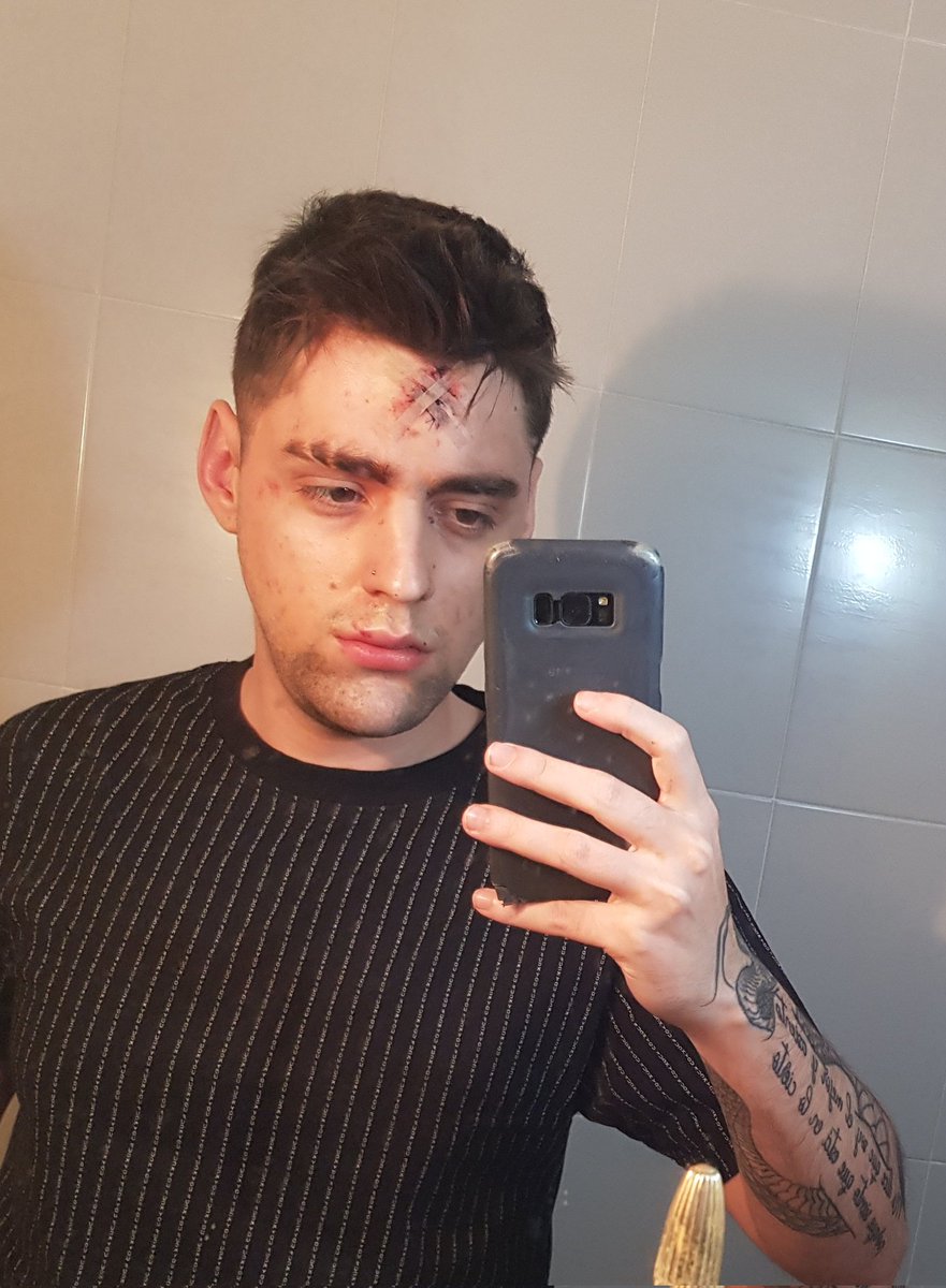 Rubenxicoo_'s tweet image. Algunos lo saben pero ayer por la noche cuando volvia a casa me pegaron una paliza y debieron darme con algo metalico en la frente (menos mal que tengo la cabeza mas dura de españa) asi que me voy a tomar dias de descanso de todo nos vemos pipas💜 #GoBisons #GoSB