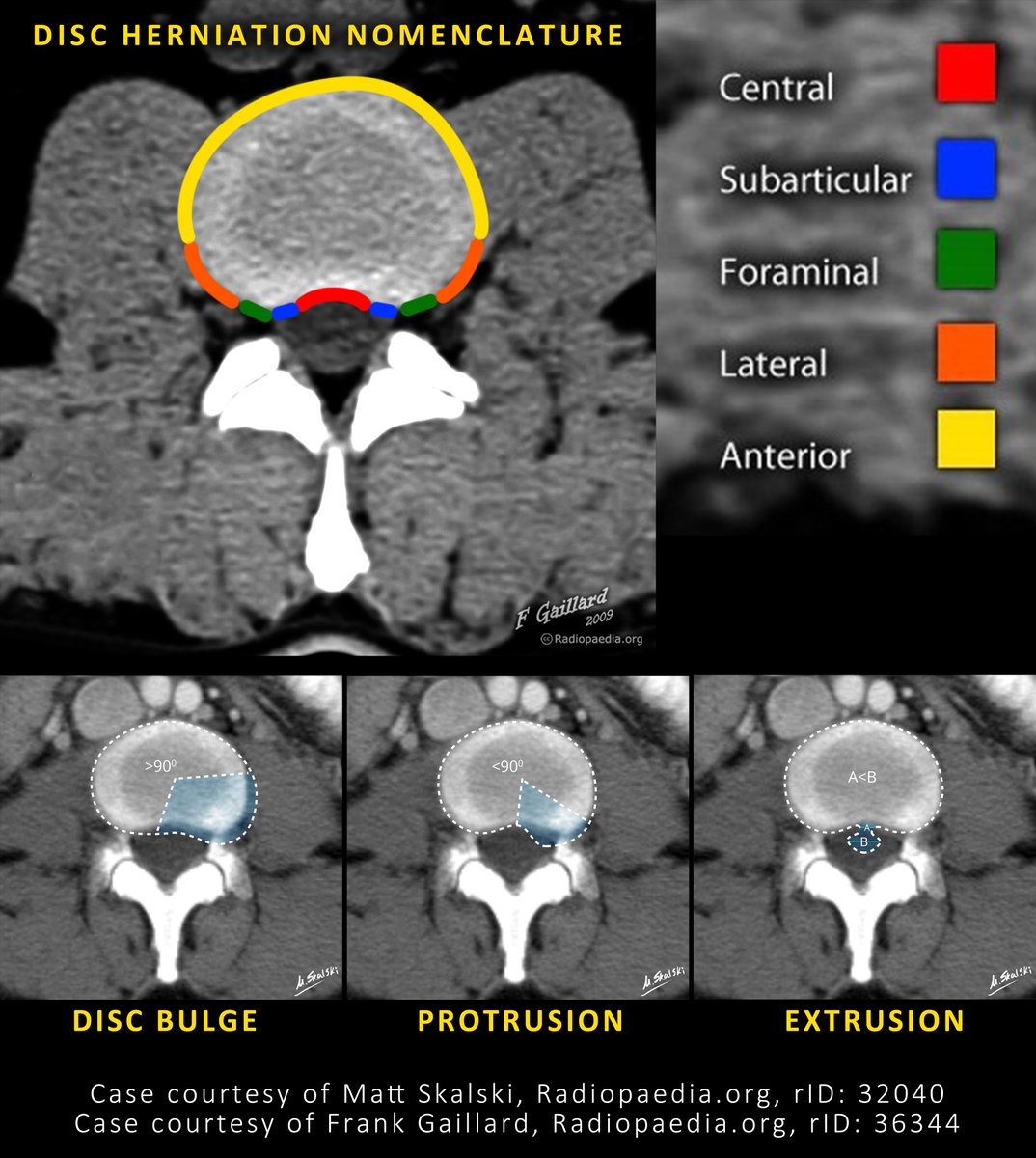 Compiled these excellent images from <a href="/Radiopaedia/">Radiopaedia.org</a> into 1 image.
