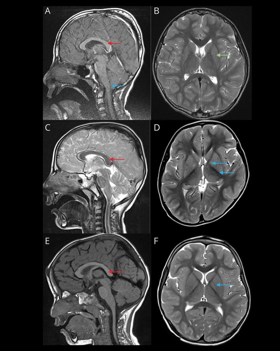 Clinical Phenotype in Individuals With Birk-Landau-Perez Syndrome Associated With Biallelic SLC30A9 Pathogenic Variants: bit.ly/3IyZchS

#NeuroTwitter