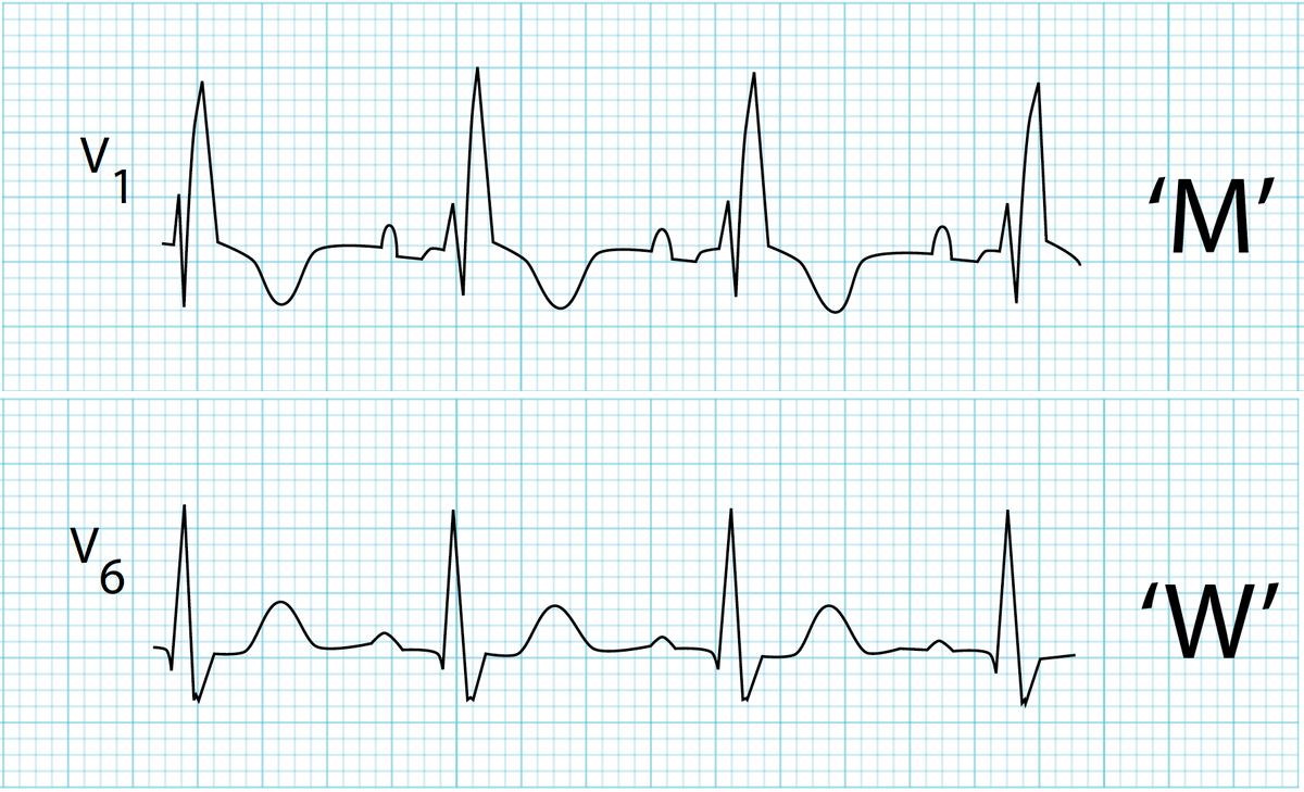 walinjom's tweet photo. Causes of RBBB

-normal variant - more common with increasing age

-right ventricular hypertrophy

-chronically increased right ventricular pressure - e.g. cor pulmonale

-pulmonary embolism

-myocardial infarction

-atrial septal defect (ostium secundum)

-cardiomyopathy or myocarditis