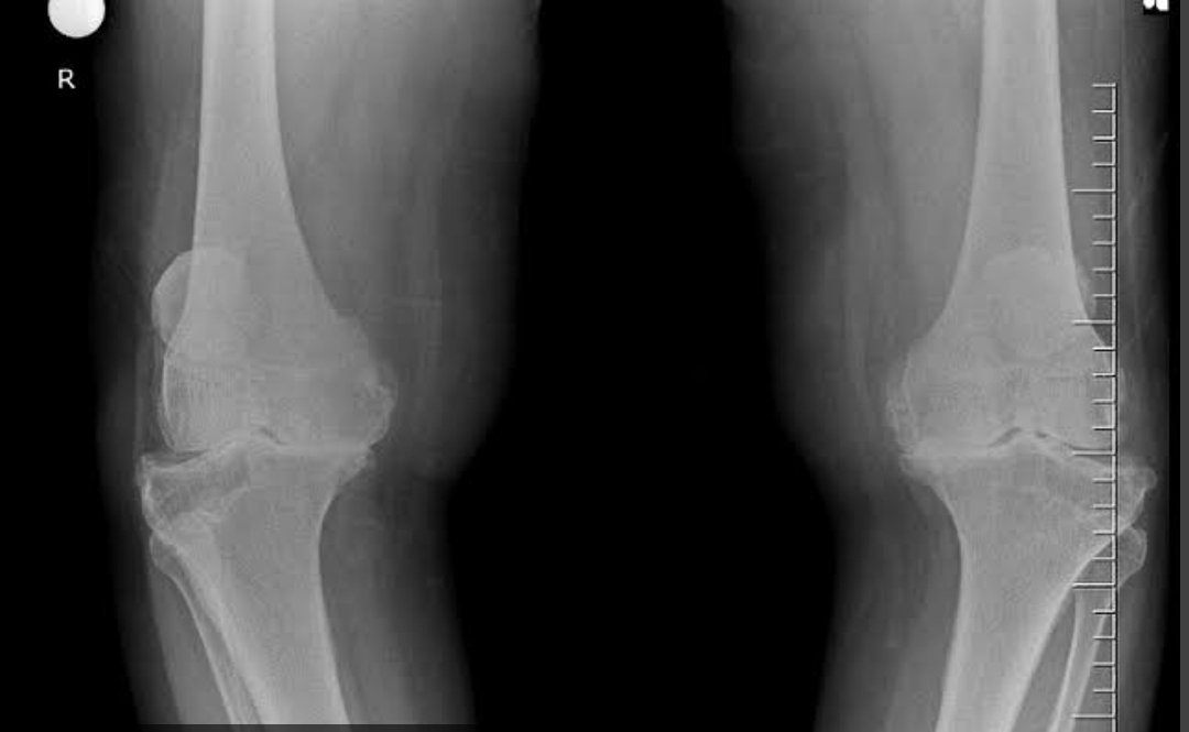 Kondisi osteoarthritis/pengapuran/kerusakan sendi lutut yang sudah berat, memang pengobatannya dgn operasi penggantian lutut.

ini adalah penyakit degeneratif,lutut rusak karena beban puluhan tahun, trus kalo tiba2 sembuh itu ibarat orang jadi muda lagi, mungkin?
-thread santai-