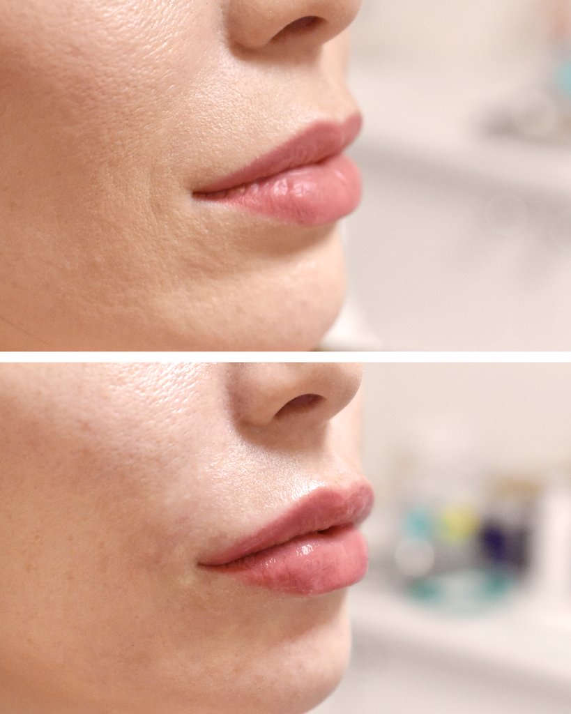 A refresh of the lips for this patient 👄💧

Rupesh is a skilled injector who can help enhance your natural beauty to achieve a more balanced, symmetrical appearance. ⁠
⁠
#lipfiller #dermalfillers #fillers #Harleystreet #dermalfiller #beauty #lips #lipfillerlondon