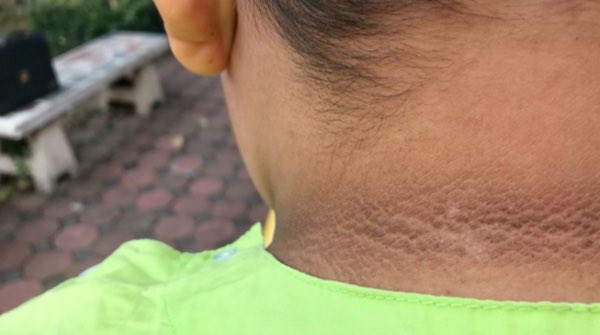 tanay_mandowara's tweet photo. If your skin is darkening on your neck, it’s a clear sign of insulin resistance.

Insulin resistance is the first step to  lifelong misery.

Better tackle it now before it gets late. https://t.co/xSNntLaUWc