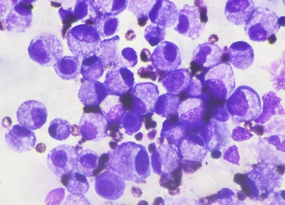 pepeheffernan's tweet photo. CC282. Gloomy Sunday case. Let's do it Sanjay style @smlungpathguy Ascites. "Can you guess how many immunostains were done and why?" #cytopath
@DrBMcGinn @goziemnweke @pembeoltulu @kriyer68 @saada_vsaada  @DrGeeONE @DrJuhlin @dr_amenona @VHNguyenMD @DrMarkOng @twmarkc @Histiocita https://t.co/7AoNahZRsA