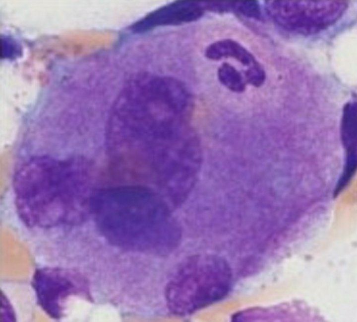 What is this condition?
A.Necroptosis
B.Pyroptosis
C.Emperipolesis
D.Entosis
#pathology #MedTwitter #medicalstudents #MedEd #Clinical #cell #hematology