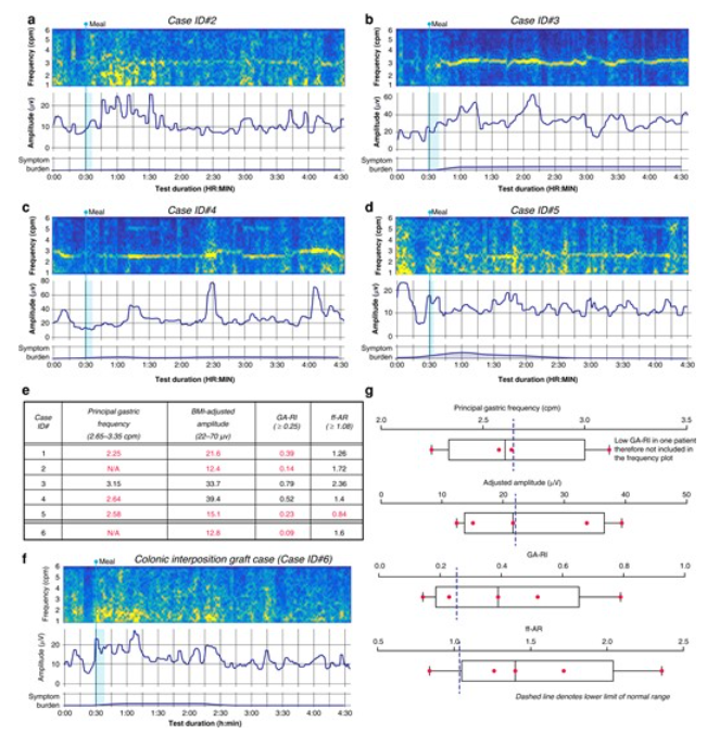 BjsOpen's tweet photo. #ICYMI the study on how a new device measuring gastric electrophysiology and function at high resolution can potentially be used in patients with postoesophagectomy conduit dysfunction:
https://t.co/jfIiUwSoVD
#SoMe4Surgery #some4UGI #uppergi #esophagealcancer https://t.co/uplMKcpZO6