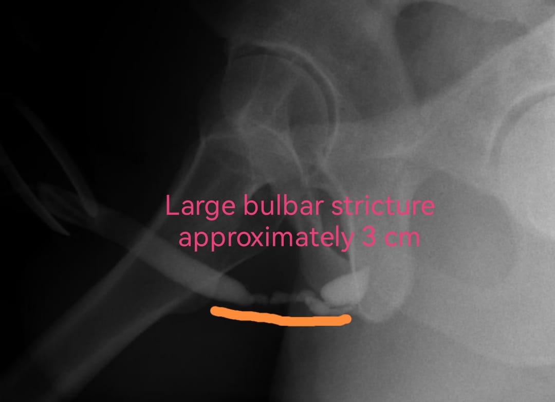 OTosev's tweet photo. On these pictures https://t.co/Kp4p9GaadA.univ.Georgi #Tosev shows how to place #Optilume-Ballon correctly to treat large bulbar stricture (approximately 3 cm) https://t.co/Oxqceyp7Aw