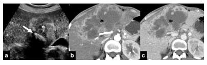 Mass replacing the gallbladder. (a) USG of a patient of GBC showing a heteroechoic mass replacing the GB (asterisk) with a large calculus within (arrow). (b, c) Axial CT scans in arterial (b) and venous (c) phases showing a large heterogeneously enhancing mass (asterisk)