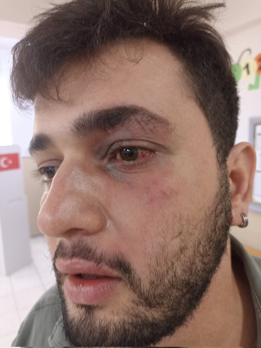 min_mtake's tweet image. Antakya Demirköprü Muhtar Abdurrahman Çetiner İlkokulu. Müşahit olduk. Kuzenim (solda) kafasına tekmeler yedi, abim (sağda) darp edildi. 
Okulda iki sandık var. İkisinde de usulsüzlükler oldu. Kabine birlikte girmeler, kimliksiz oy kullanmalar... Kuzenimin itiraz ettiği görülünce