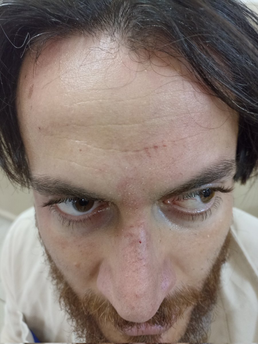 Antakya Demirköprü Muhtar Abdurrahman Çetiner İlkokulu. Müşahit olduk. Kuzenim (solda) kafasına tekmeler yedi, abim (sağda) darp edildi. 
Okulda iki sandık var. İkisinde de usulsüzlükler oldu. Kabine birlikte girmeler, kimliksiz oy kullanmalar... Kuzenimin itiraz ettiği görülünce