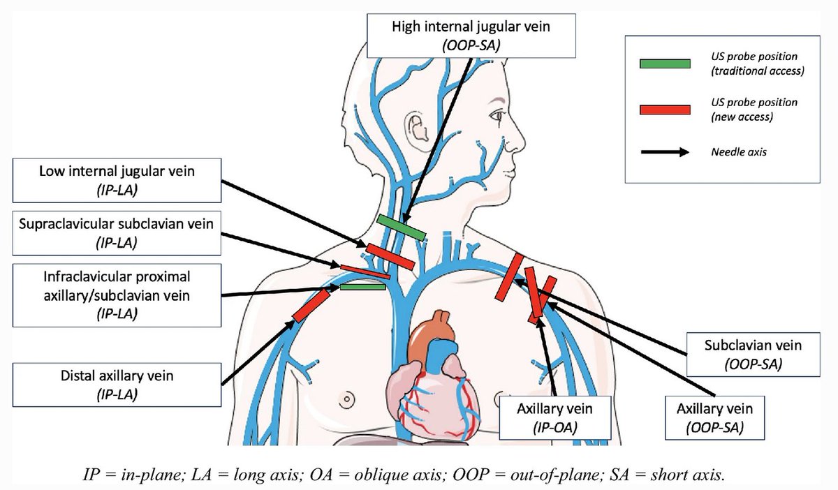 How to improve the efficiency and the safety of real-time ultrasound-guided central venous catheterization 

CCR Journal Watch
criticalcarereviews.com/latest-evidenc…