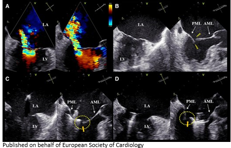 ESC_Journals's tweet photo. How can a ventilator come in useful for Mitraclip procedure? Read more here https://t.co/fRiqaLuscP

#EHJCaseReports #echofirst @aayshacader @KardiologieHH @ANazmiCalik  @EHJCREiC @TJ_Yeo  @Phiso_de @FarhanaAra https://t.co/AzJ0o7YIgP