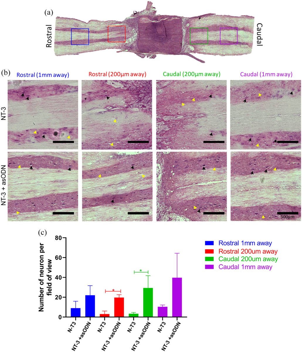Journal of Tissue Engineering (@jtisseng) on Twitter photo asODNs can be used to downregulate connexin, a gap junction protein which is involved in the spread of cell death signals in spinal cord injury. Hydrogel scaffold delivery of these molecules allows for guided regeneration. shorturl.at/FHI12 #neuroscience <a href="/NTU_LKCMedicine/">LKCMedicine</a> asODNs can be used to downregulate connexin, a gap junction protein which is involved in the spread of cell death signals in spinal cord injury. Hydrogel scaffold delivery of these molecules allows for guided regeneration. shorturl.at/FHI12 #neuroscience <a href="/NTU_LKCMedicine/">LKCMedicine</a>