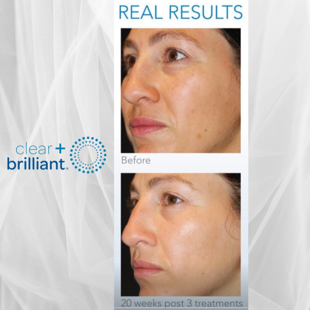 Non-invasive skin resurfacing with little downtime. Look your best!

#clearandbrilliant #bebrilliant #clearandbrilliantlaser #laserfacial #laserskincare #skincare #beauty #skin #aesthetic #skingoals #glowingskin #glowup