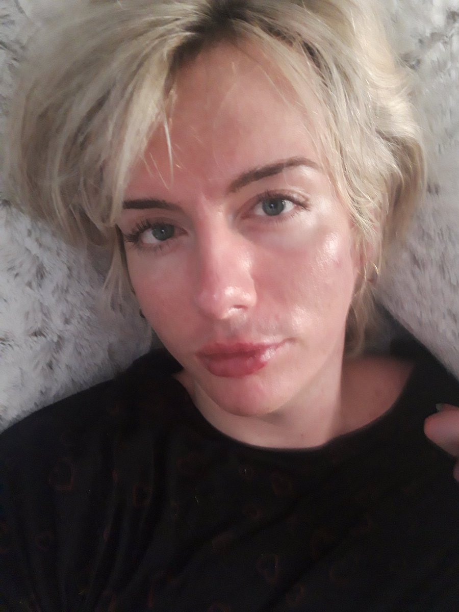 ScarlettDebbies's tweet photo. the day i came out // now

Pre hrt, Pre surgery but I have had some Dermal fillers. I wanted to come out at 17 when I knew who I was, but hid myself away until 27. Alot had changed in the past 18 months! https://t.co/oLmCdoO5jk