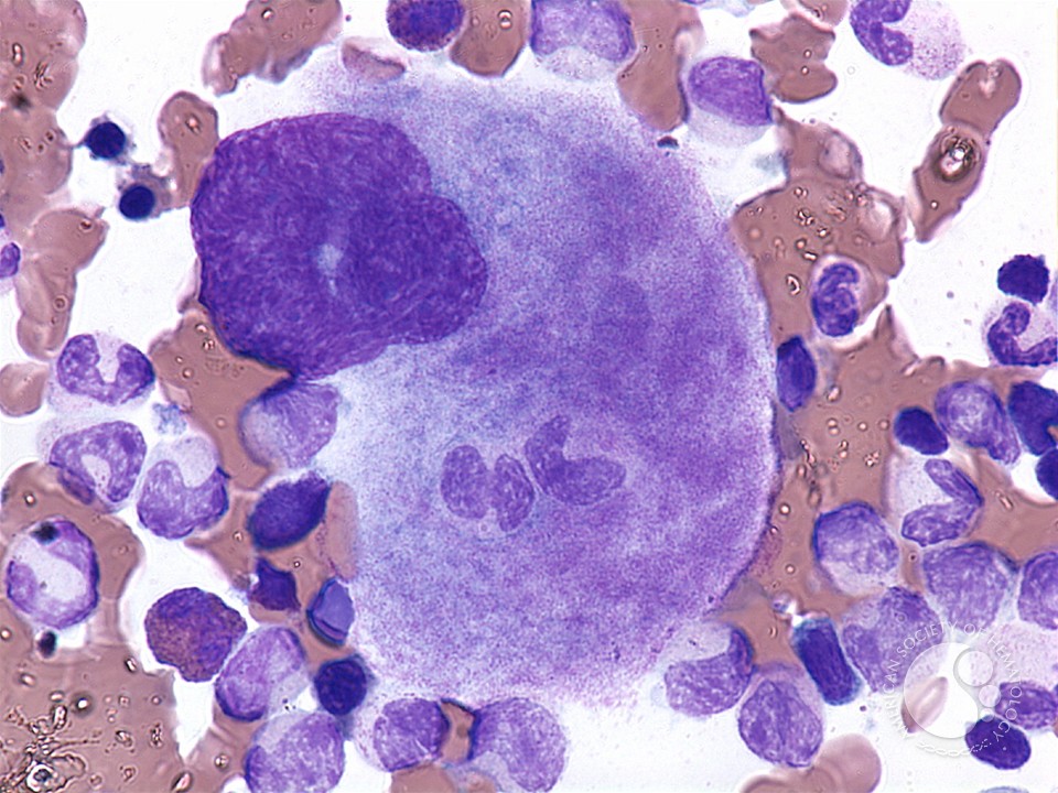 Answer: Emperipolesis/cell-in-cell phenomenon✅

It is a condition where the hematopoietic stem cells are seen in living and intact state, and are seen in the cytoplasm of the host cell without any damage.

✓Neutrophils,lymphocytes &plasma cells are frequently taken in.
