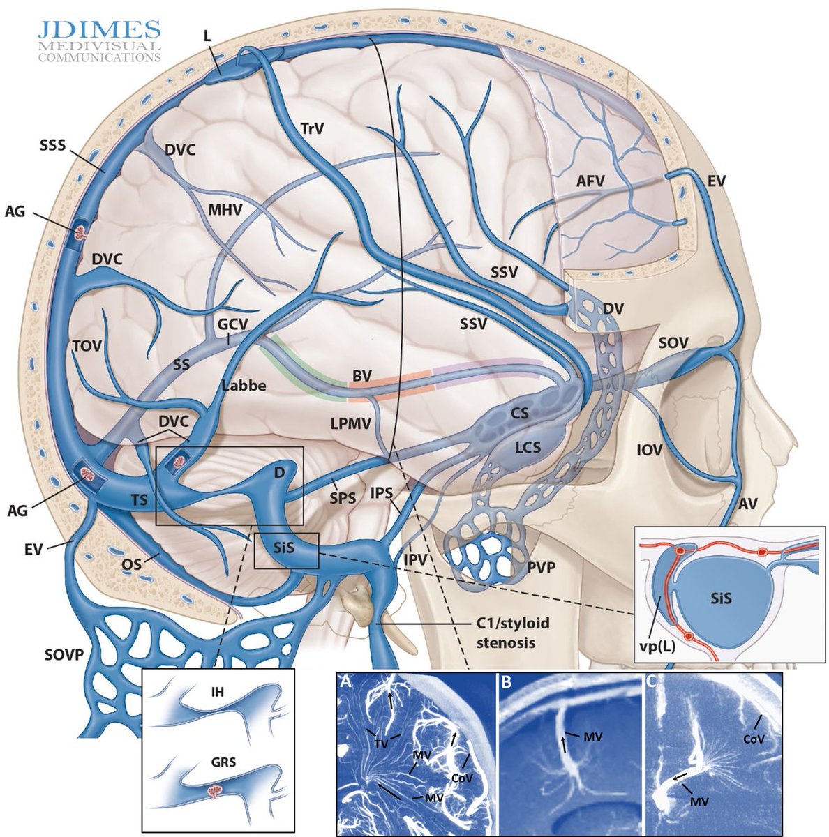 Schematic of cranial and upper cervical venous systems.

Source: Maksim Shapiro et al., 2022

#MedTwitter