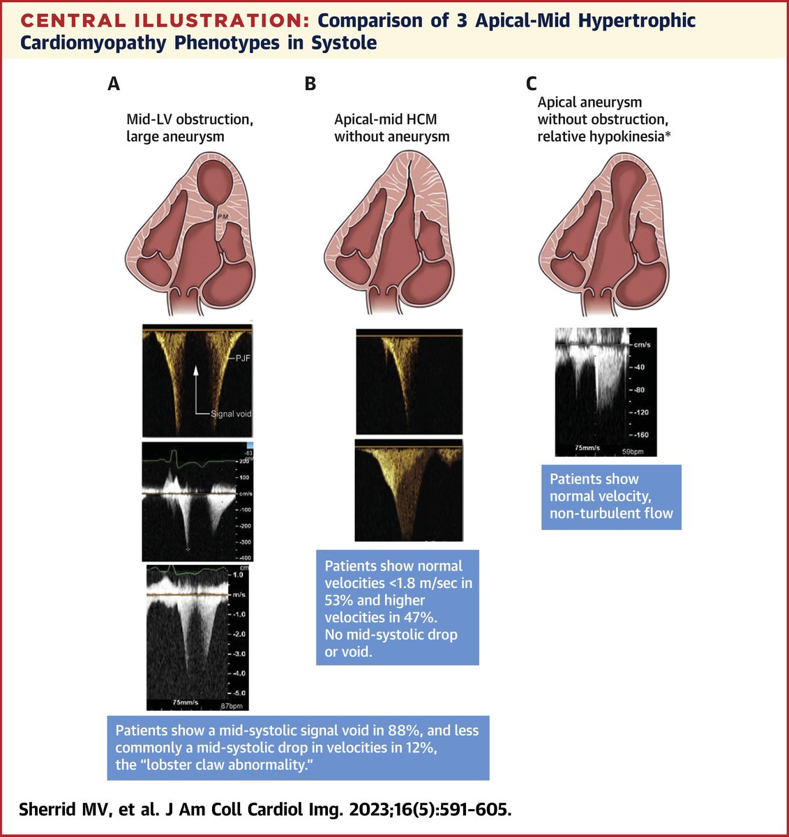 ICYMI: 95% of patients with hypertrophic #cardiomyopathy and apical aneurysms have mid-ventricular obstruction. bit.ly/3noxgWm

#echofirst #cvHCM #JACCIMG
